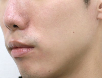 [나인의원홍대] 홍대피부과, 홍조는 평생 안고 가야한다고? 사진 2