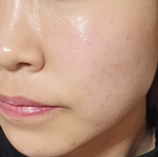 [나인의원홍대] 홍대피부과 리쥬란, 엠보 때문에 걱정된다면 꼭 읽어주세요. 사진 7