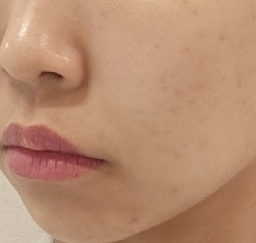 [나인의원홍대] 홍대피부과 리쥬란, 엠보 때문에 걱정된다면 꼭 읽어주세요. 사진 6