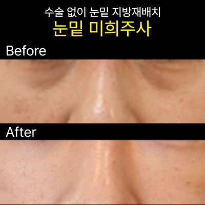 [나인의원홍대] 홍대피부과, 필러말고 다른건 없나요에 대한 솔직한 이야기.