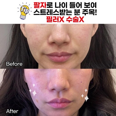 [나인의원홍대] 홍대피부과, 필러말고 다른건 없나요에 대한 솔직한 이야기. 사진 2