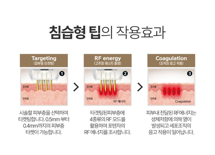 홍대피부과, 포텐자 진짜 효과 있을까? 의사가 답변해 드립니다. 사진 5