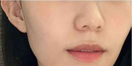 홍대피부과 해골형,땅콩형얼굴이 고민이라면? 수술말고 이것부터 해보세요! 사진 8