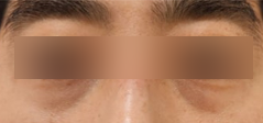 홍대피부과 해골형,땅콩형얼굴이 고민이라면? 수술말고 이것부터 해보세요! 사진 13
