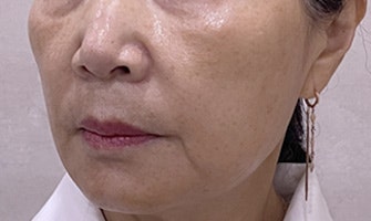 홍대피부과 해골형,땅콩형얼굴이 고민이라면? 수술말고 이것부터 해보세요!