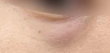 홍대피부과 해골형,땅콩형얼굴이 고민이라면? 수술말고 이것부터 해보세요! 사진 15