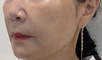 홍대피부과 해골형,땅콩형얼굴이 고민이라면? 수술말고 이것부터 해보세요! 사진 6