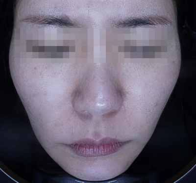 홍대피부과 해골형,땅콩형얼굴이 고민이라면? 수술말고 이것부터 해보세요! 사진 3