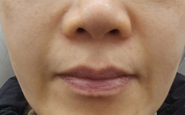 홍대피부과 해골형,땅콩형얼굴이 고민이라면? 수술말고 이것부터 해보세요! 사진 9