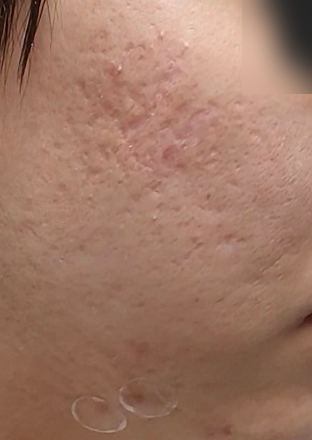 홍대입구피부과 패인 여드름흉터, 울트라펄스 앙코르로 달라질 수 있을까? 사진 6