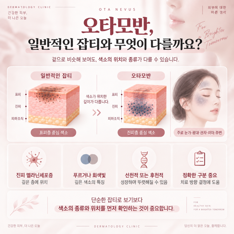 Phòng khám Da liễu Hongdae: Bớt Ota và Lý do Điều trị bằng Laser Ruby (The Ruby Q) Lại Quan Trọng