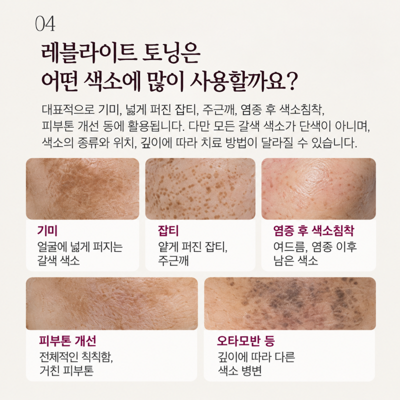 홍대피부과 색소레이저, 레블라이트 토닝은 어떤 치료일까요? 사진 5