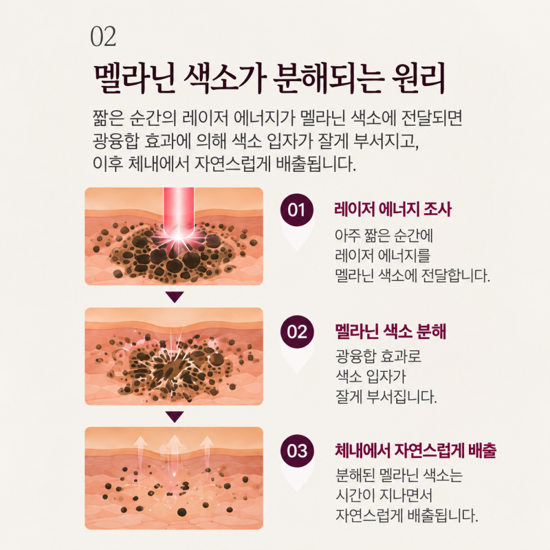 홍대피부과 색소레이저, 레블라이트 토닝은 어떤 치료일까요? 사진 3